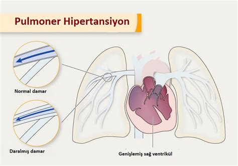 pulmoner hipertansiyon nedir